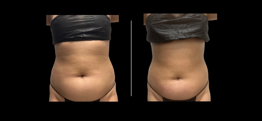 Sculptura Lipo