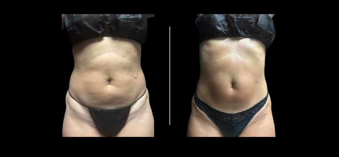 Sculptura Lipo
