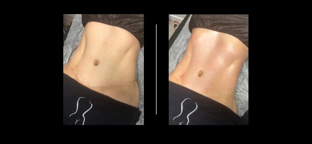 Sculptura Post Op Massages