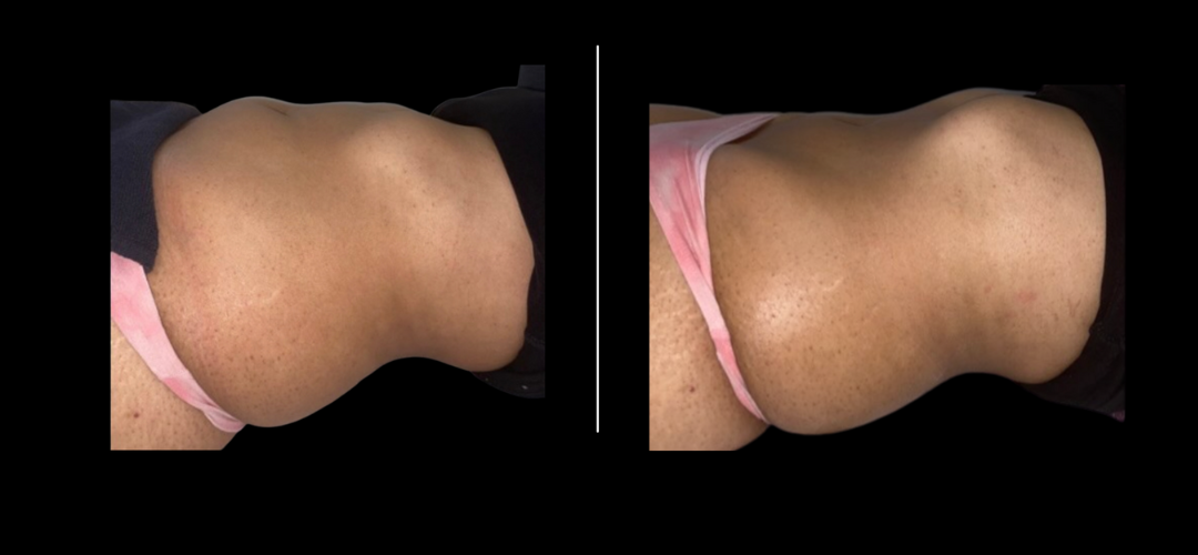 Sculptura Lipo