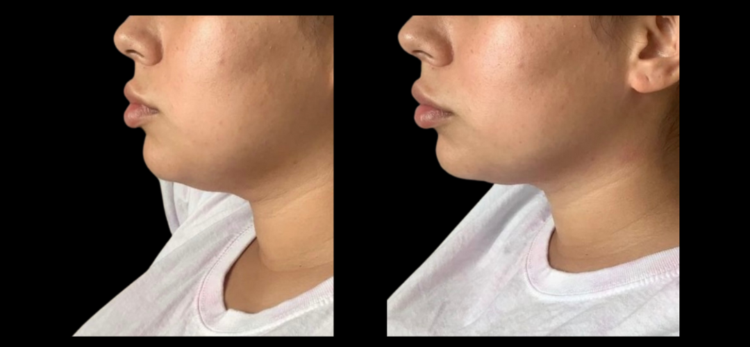 Sculptura Face Contour